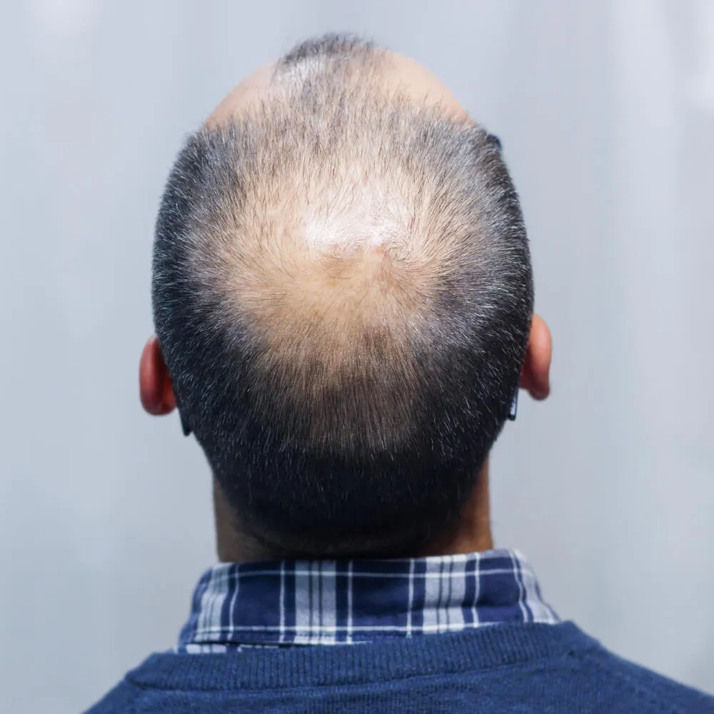 Alopecija
